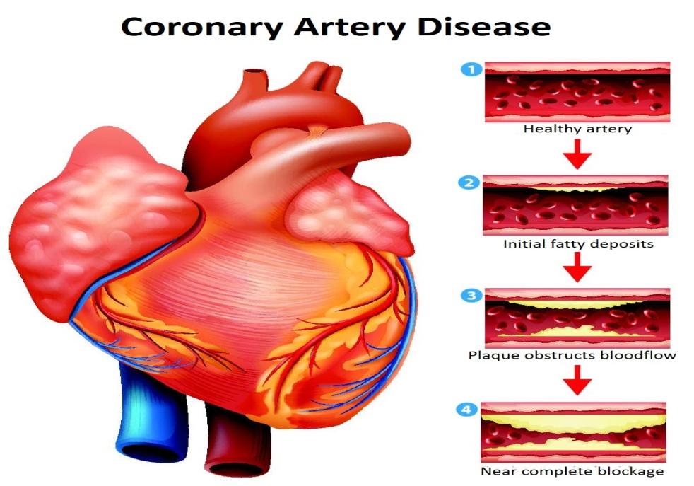 Leading Causes Of Heart Failure You Should Be Aware of