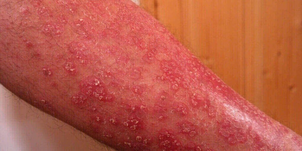 how to cure psoriasis