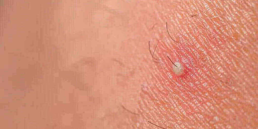 How Long Do Ingrown Hairs Last 