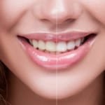 How to Get Rid of Brown Spots on Teeth