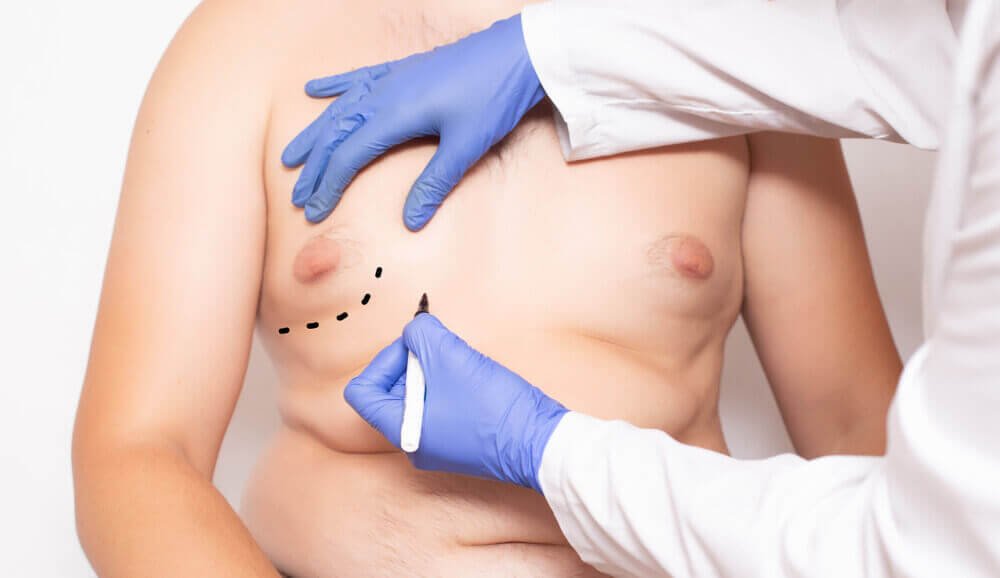 Overview of Gynecomastia Procedure