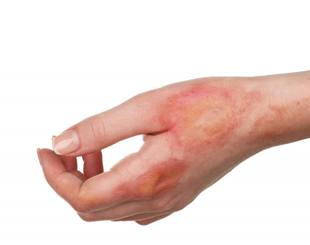 How To Treat Minor Burns At Home For Fast Healing