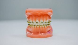 How to Avoid Teeth Cavities