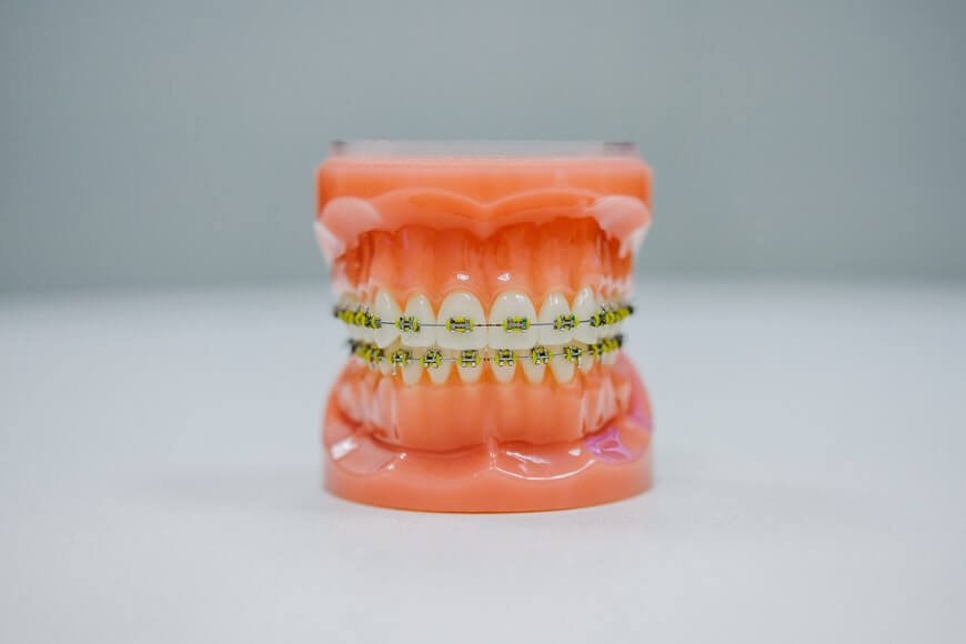How to Avoid Teeth Cavities