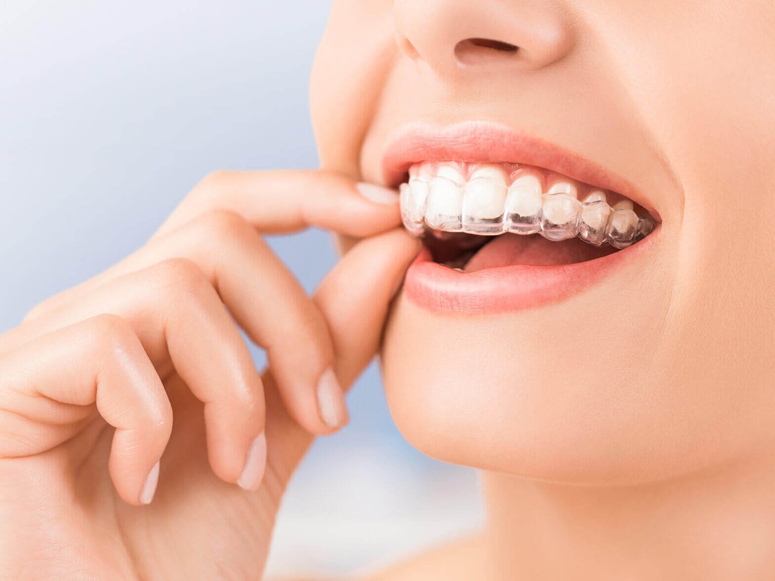 Does Invisalign Impact Your Diet
