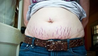 How To Effectively Get Rid Of Stretch Marks