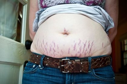 How To Effectively Get Rid Of Stretch Marks
