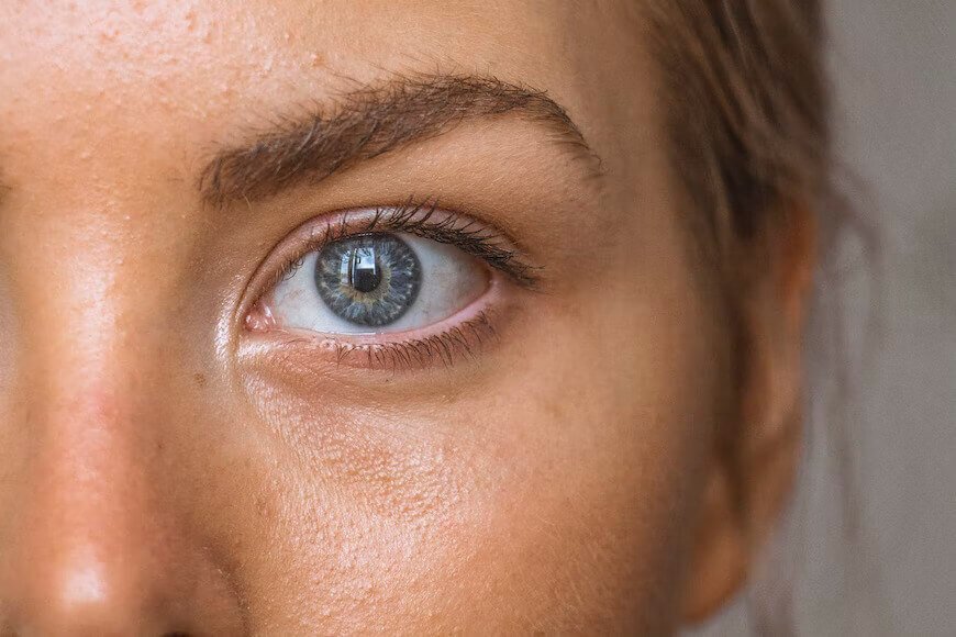 How To Remove Cholesterol (Xanthelasmas) Deposits Around Eyes Naturally