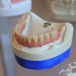 Dental Crowns vs. Veneers
