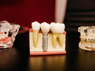 How Long Does Teeth Grinding Pain Last
